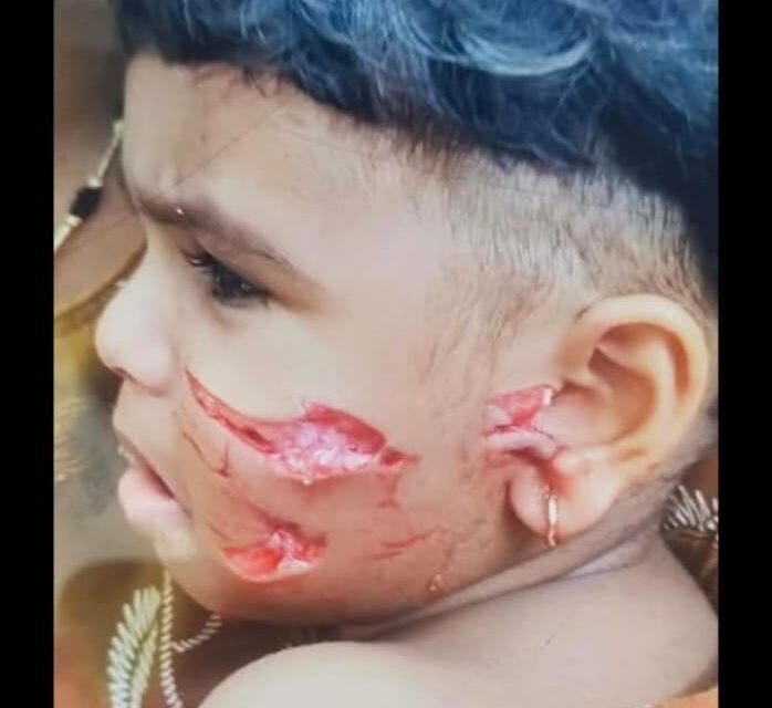 ಯಲ್ಲಾಪುರದಲ್ಲಿ ಬಾಲಕನ ಮೇಲೆ ನಾಯಿ ಭೀಕರ ಧಾಳಿ